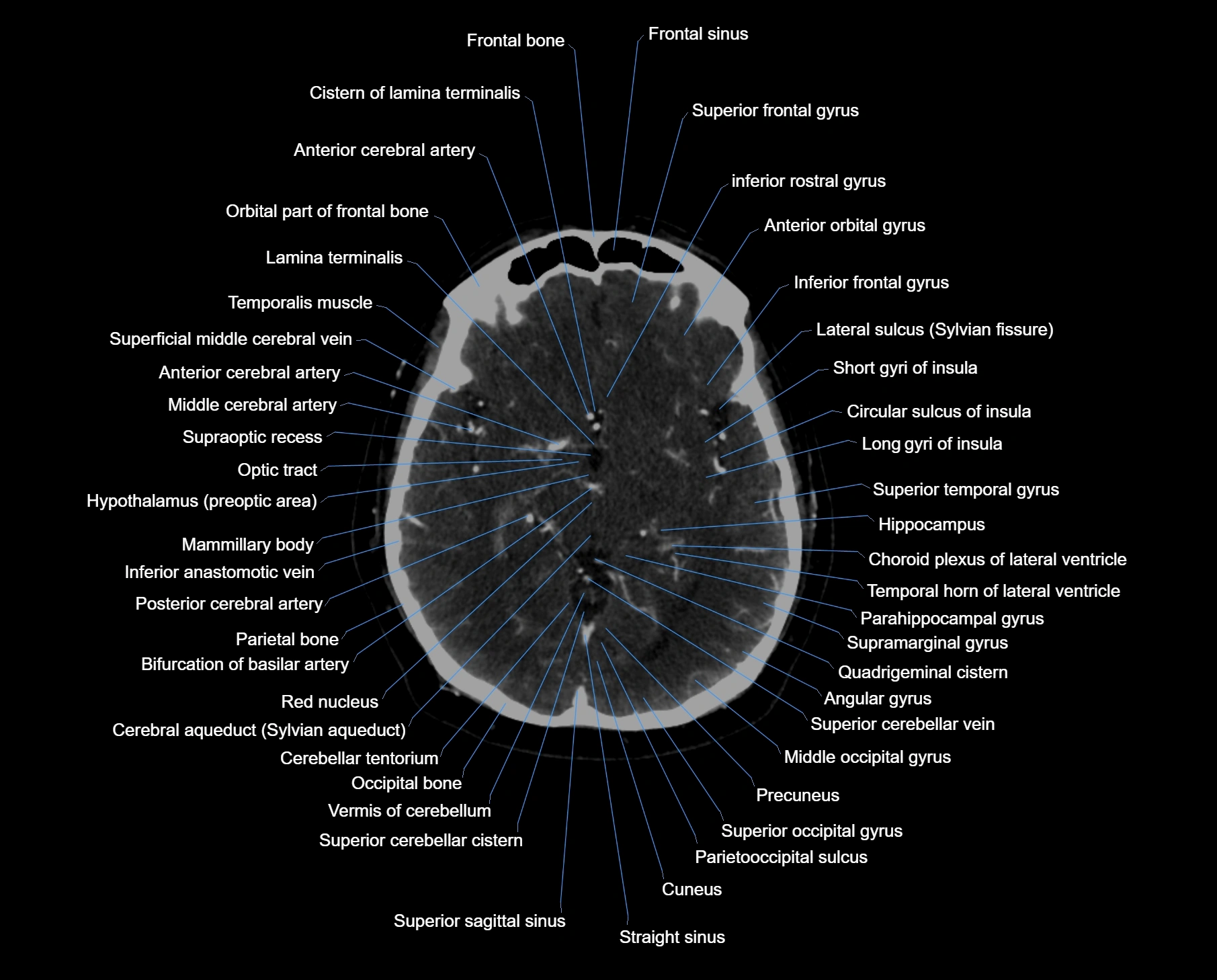 CT scan brain axial labelled cross sectional anatomy image-img-000031.webp